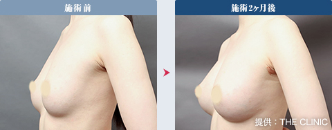 豊胸・バストアップ 症例2