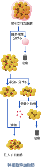 脂肪幹細胞注入のプロセス