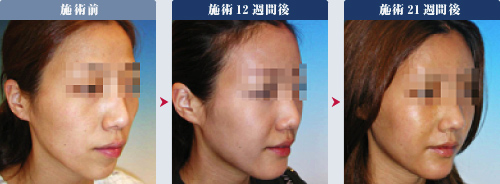 アンチエイジング（若返り療法） 症例1