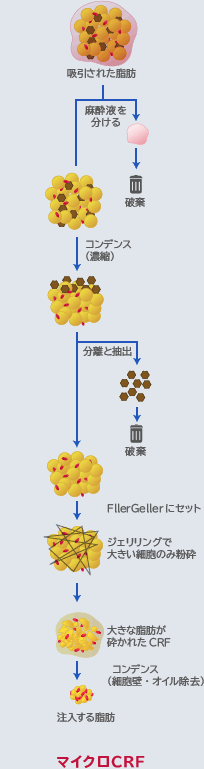 マイクロCRF（マイクロコンデンスリッチファット）注入のプロセス